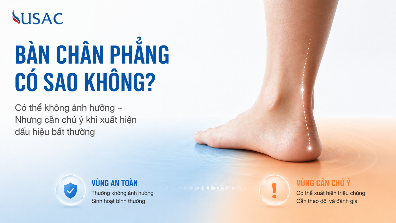 Bàn Chân Phẳng Có Sao Không Bàn Chân Phẳng Có Sao Không