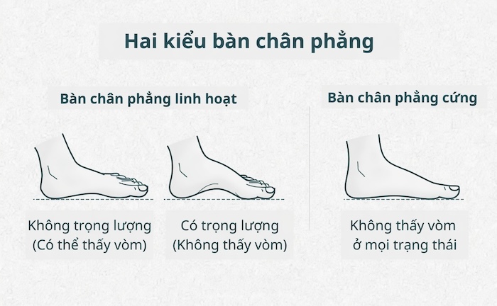 Bàn Chân Phẳng Có Ý Nghĩa Gì