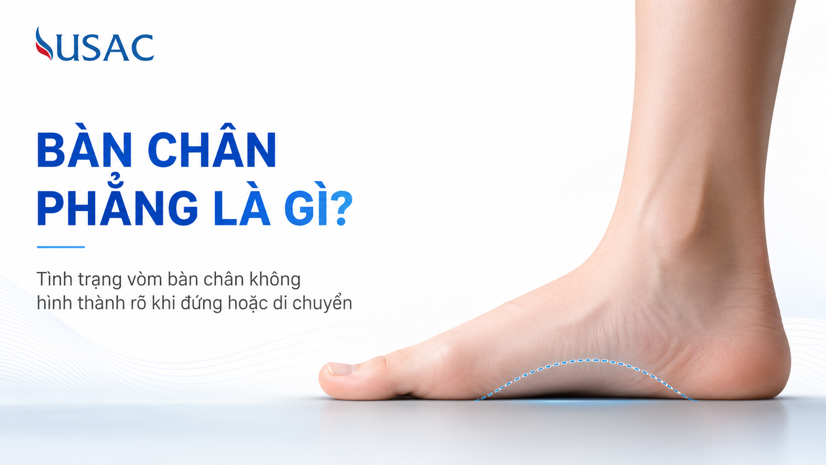 Bàn Chân Phẳng Là Gì Bàn Chân Phẳng Là Gì