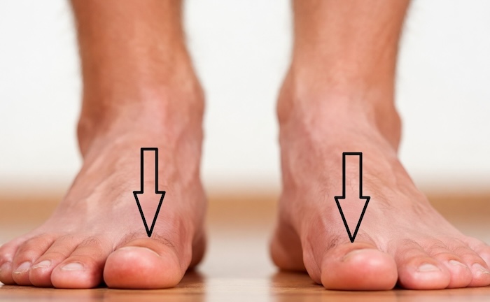 Bàn Chân Phẳng Là Sao