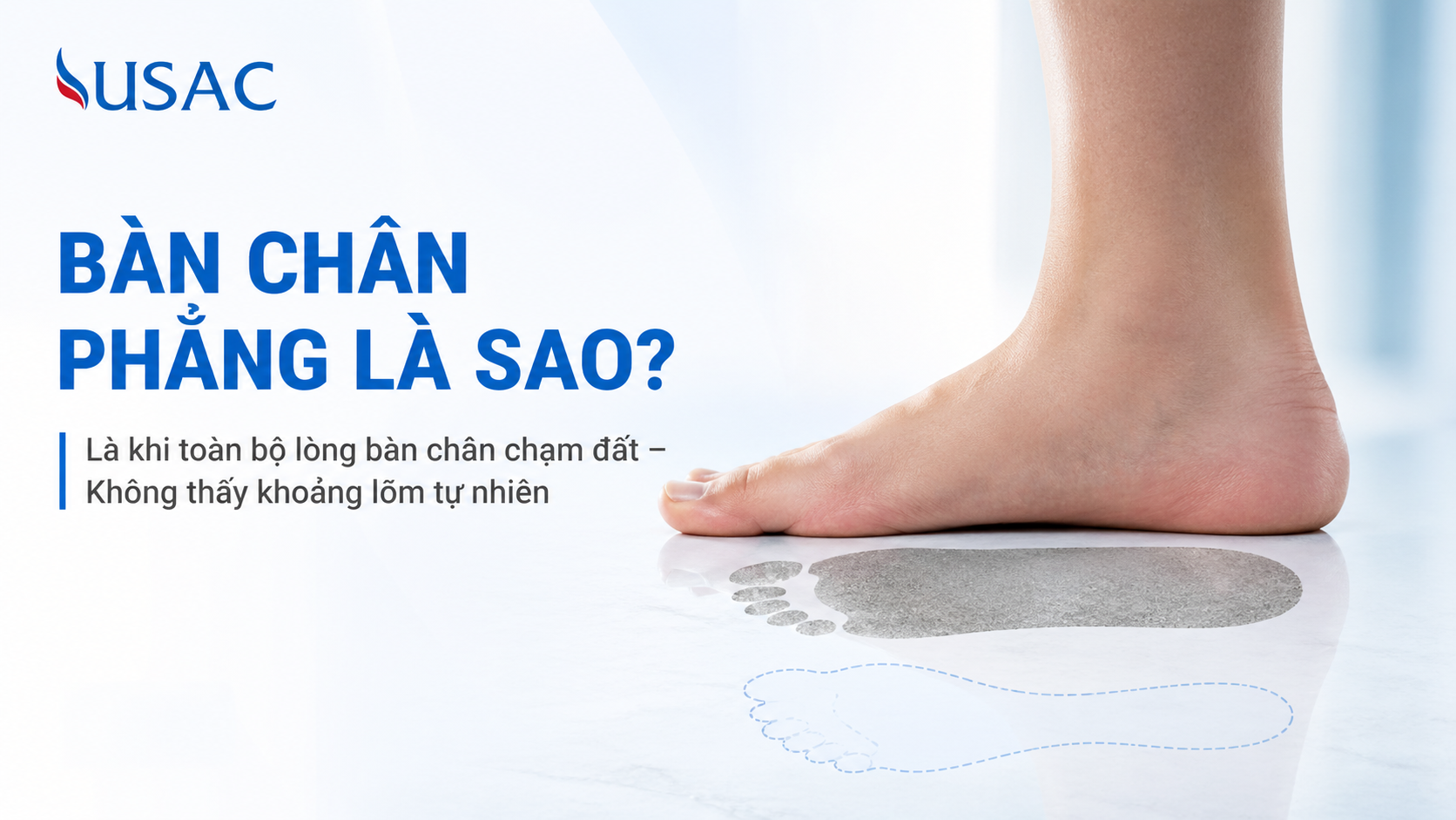 Bàn Chân Phẳng Là Sao Bàn Chân Phẳng Là Sao