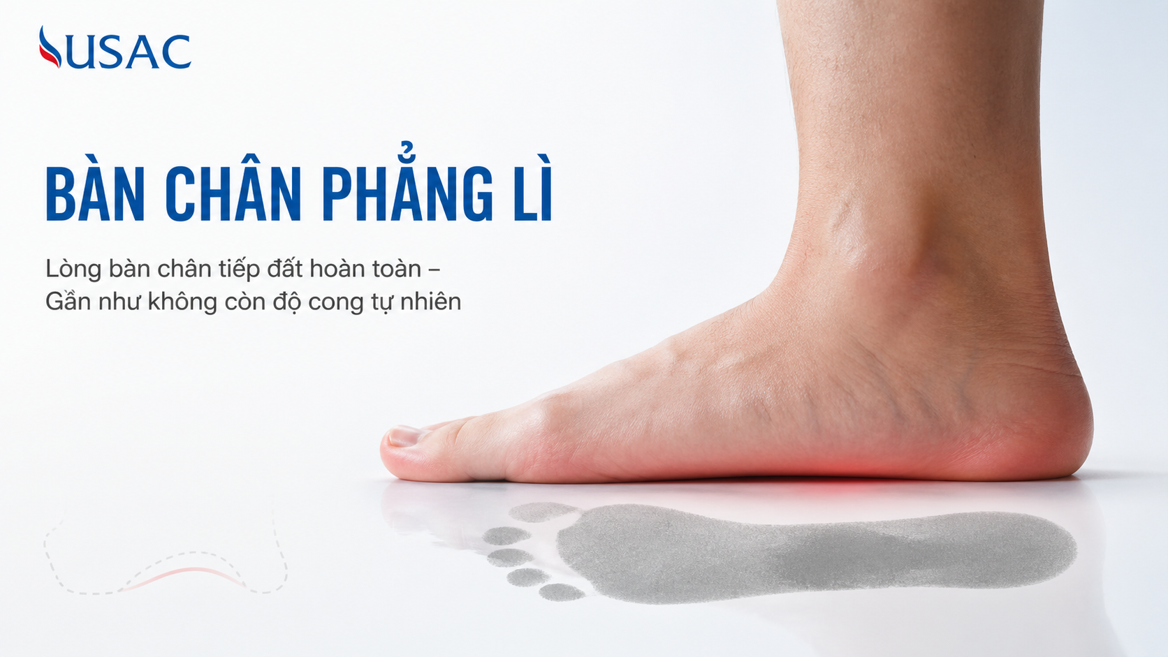 Bàn Chân Phẳng Lì Bàn Chân Phẳng Lì