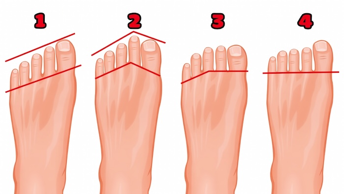 Bàn Chân Phẳng Sướng Hay Khổ