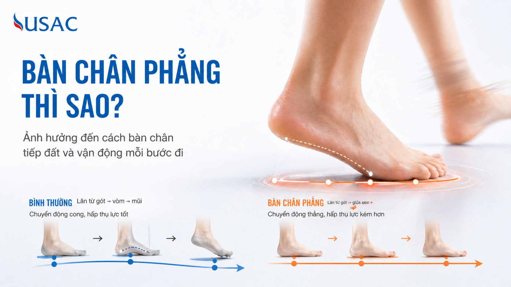 Bàn Chân Phẳng Thì Sao