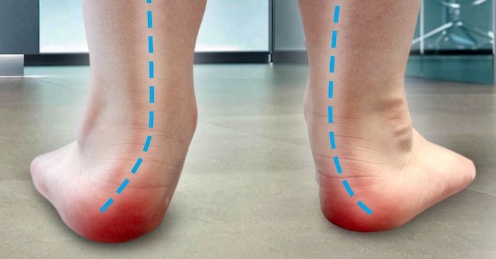 Bé 2 Tuổi Bị Bàn Chân Bẹt