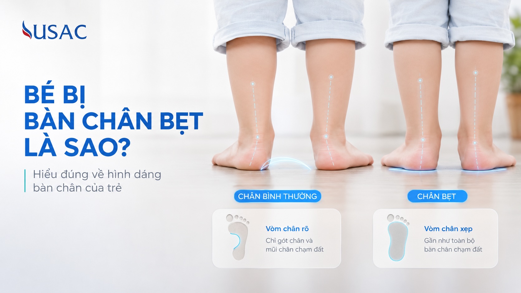Bé Bị Bàn Chân Bẹt Là Sao Bé Bị Bàn Chân Bẹt Là Sao