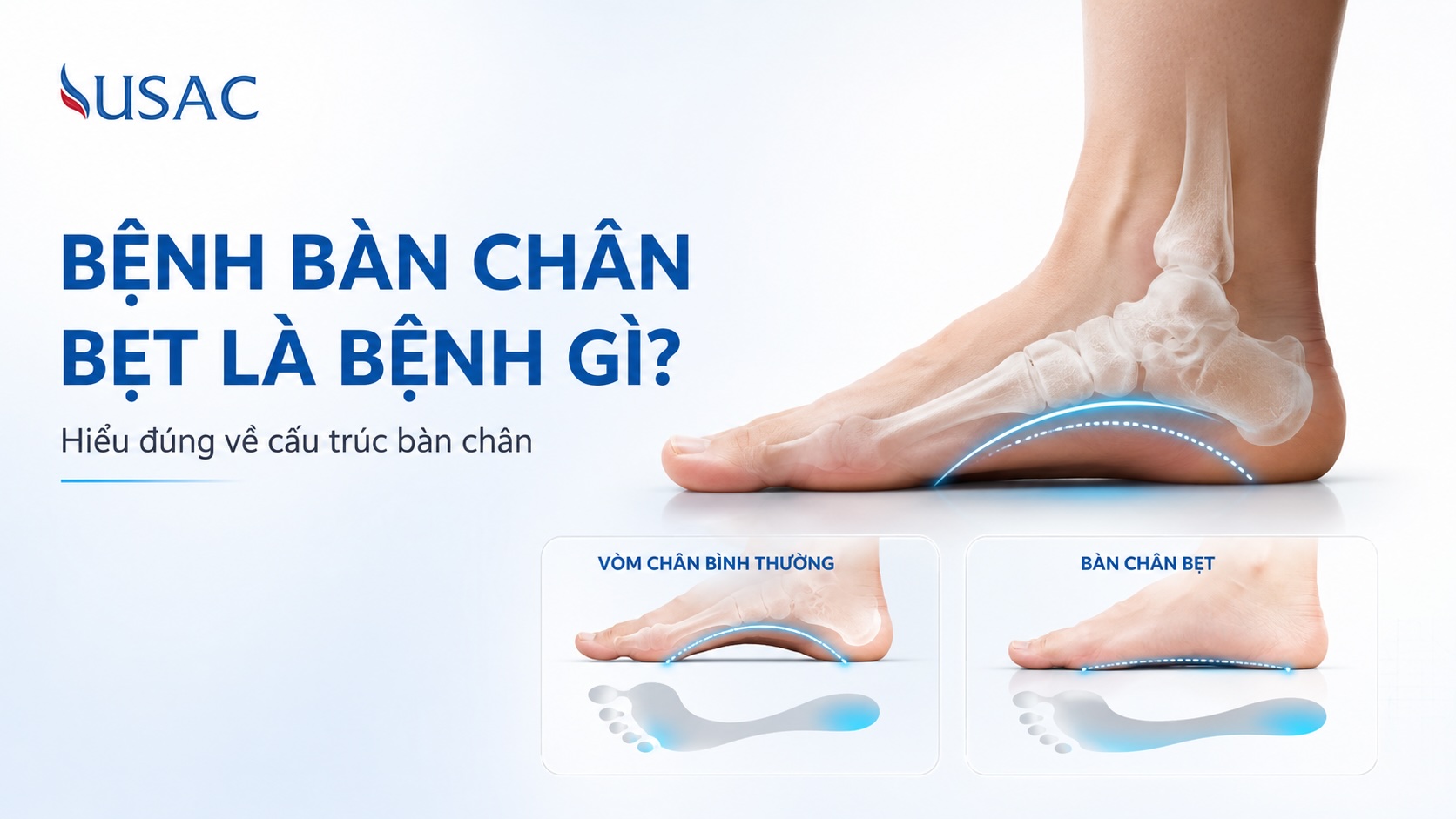 Bệnh Bàn Chân Bẹt Là Bệnh Gì Bệnh Bàn Chân Bẹt Là Bệnh Gì