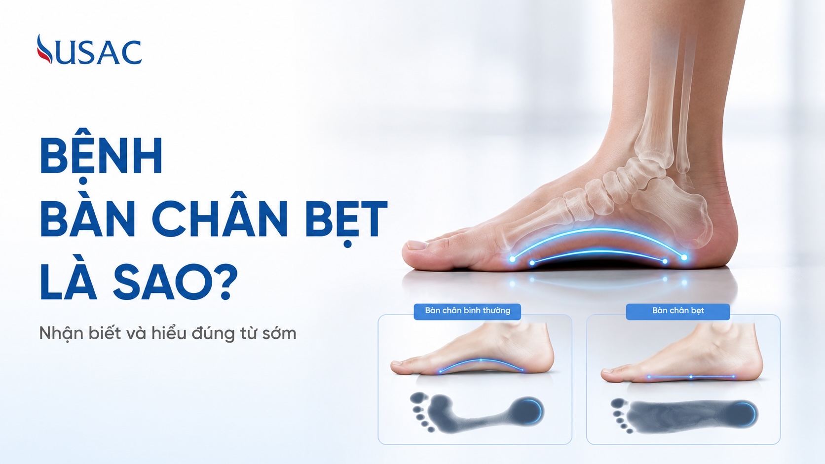 Bệnh Bàn Chân Bẹt Là Sao Bệnh Bàn Chân Bẹt Là Sao