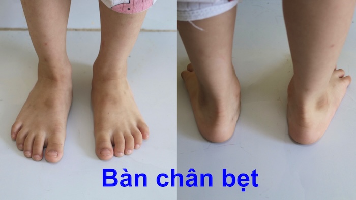 Bệnh Chân Bẹt Ở Trẻ Em