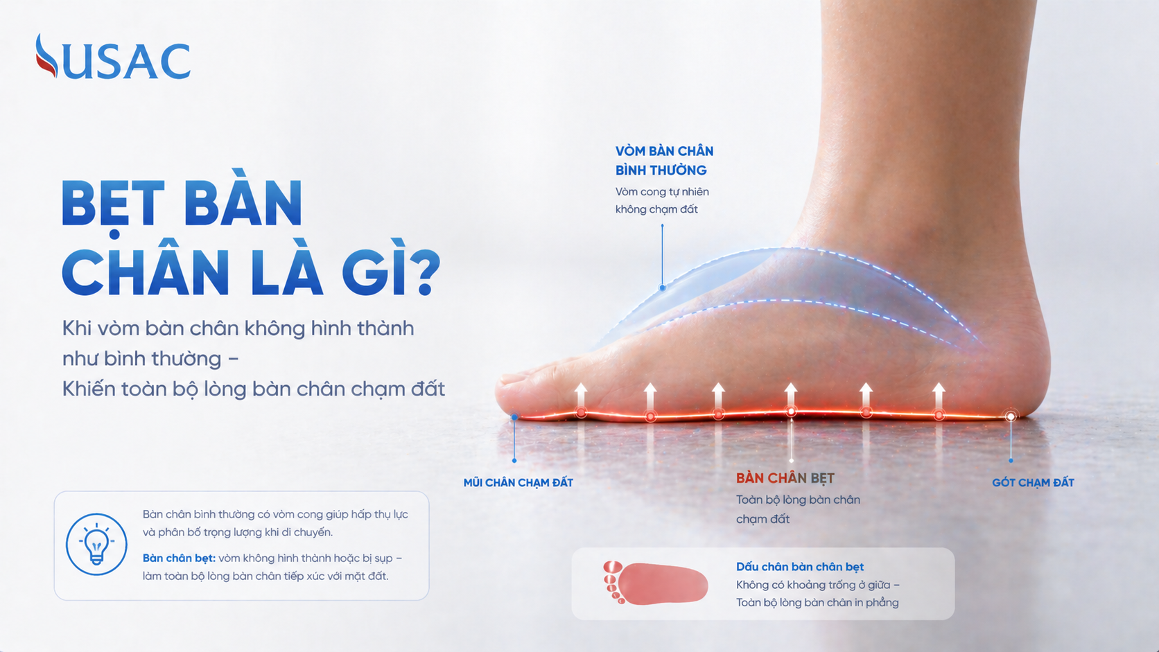 Bẹt Bàn Chân Là Gì