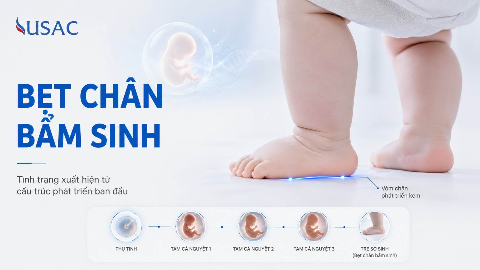 Bẹt Chân Bẩm Sinh Bẹt Chân Bẩm Sinh