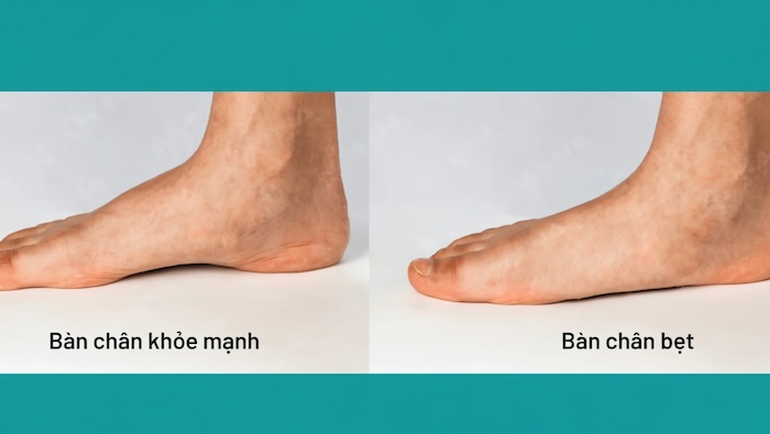 Bẹt Chân Là Gì