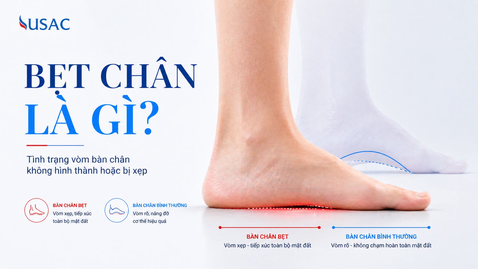 Bẹt Chân Là Gì