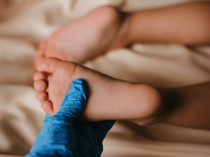 Bẹt Chân Ở Trẻ