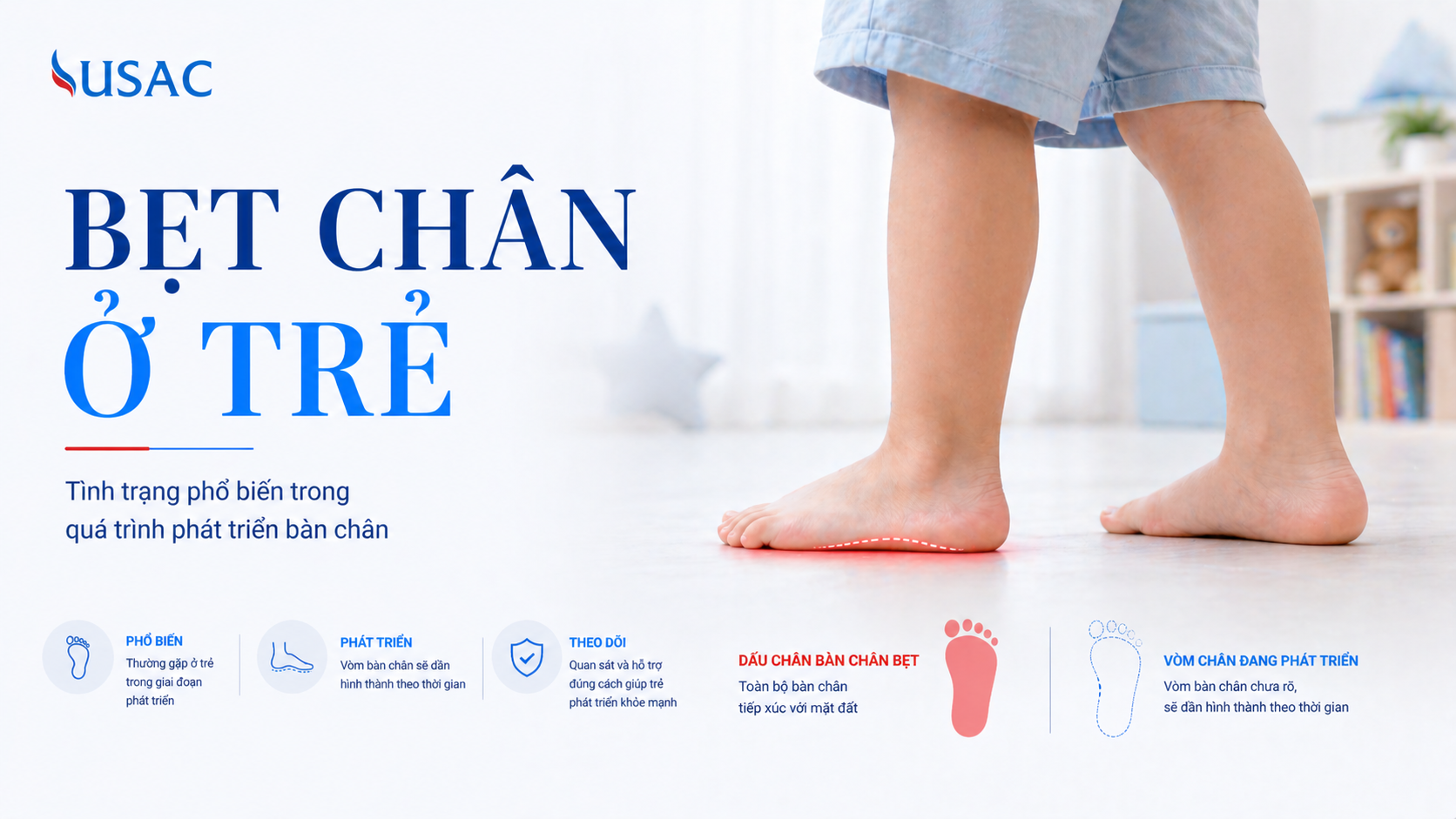 Bẹt Chân Ở Trẻ