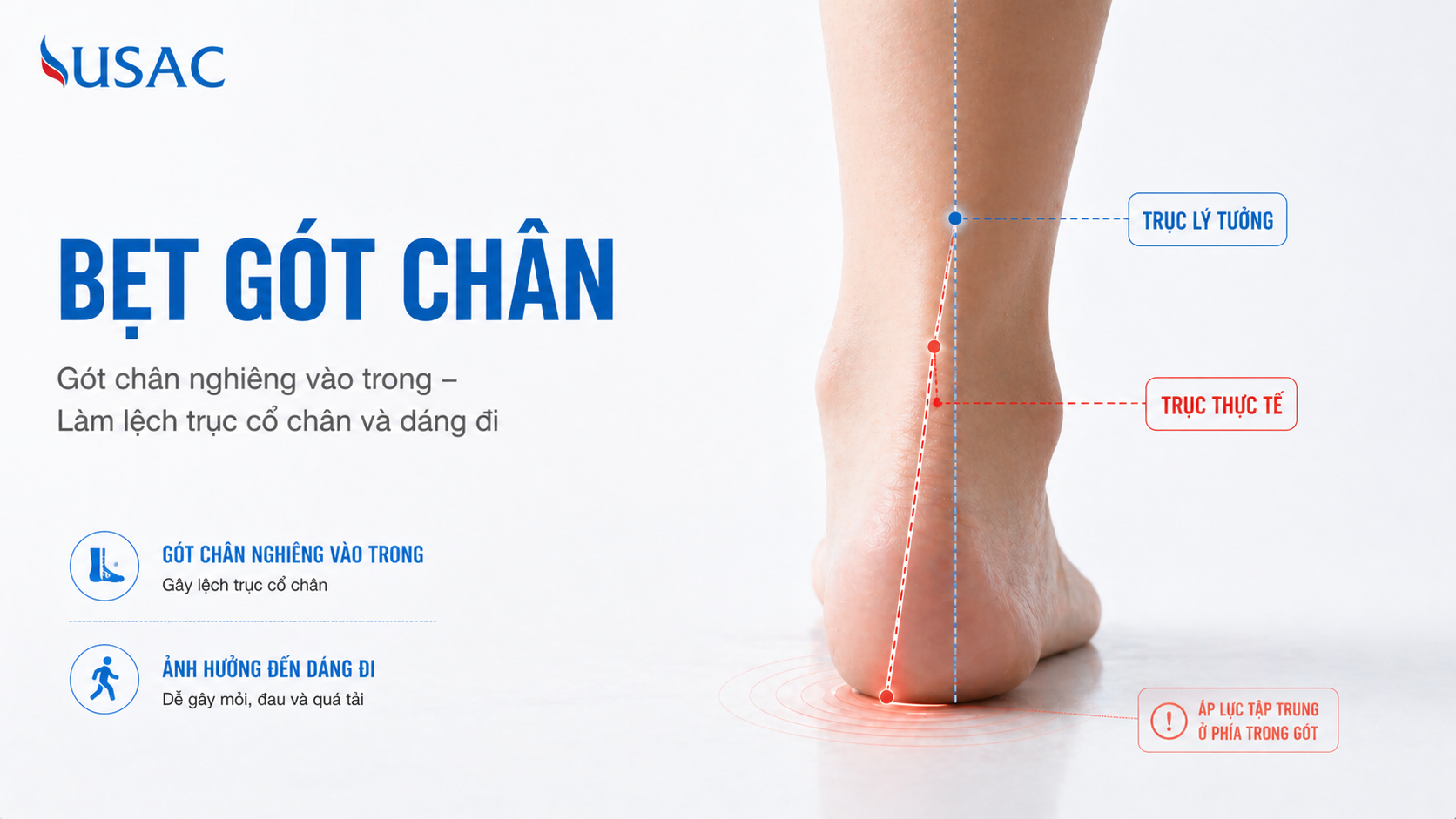 Bẹt Gót Chân Bẹt Gót Chân