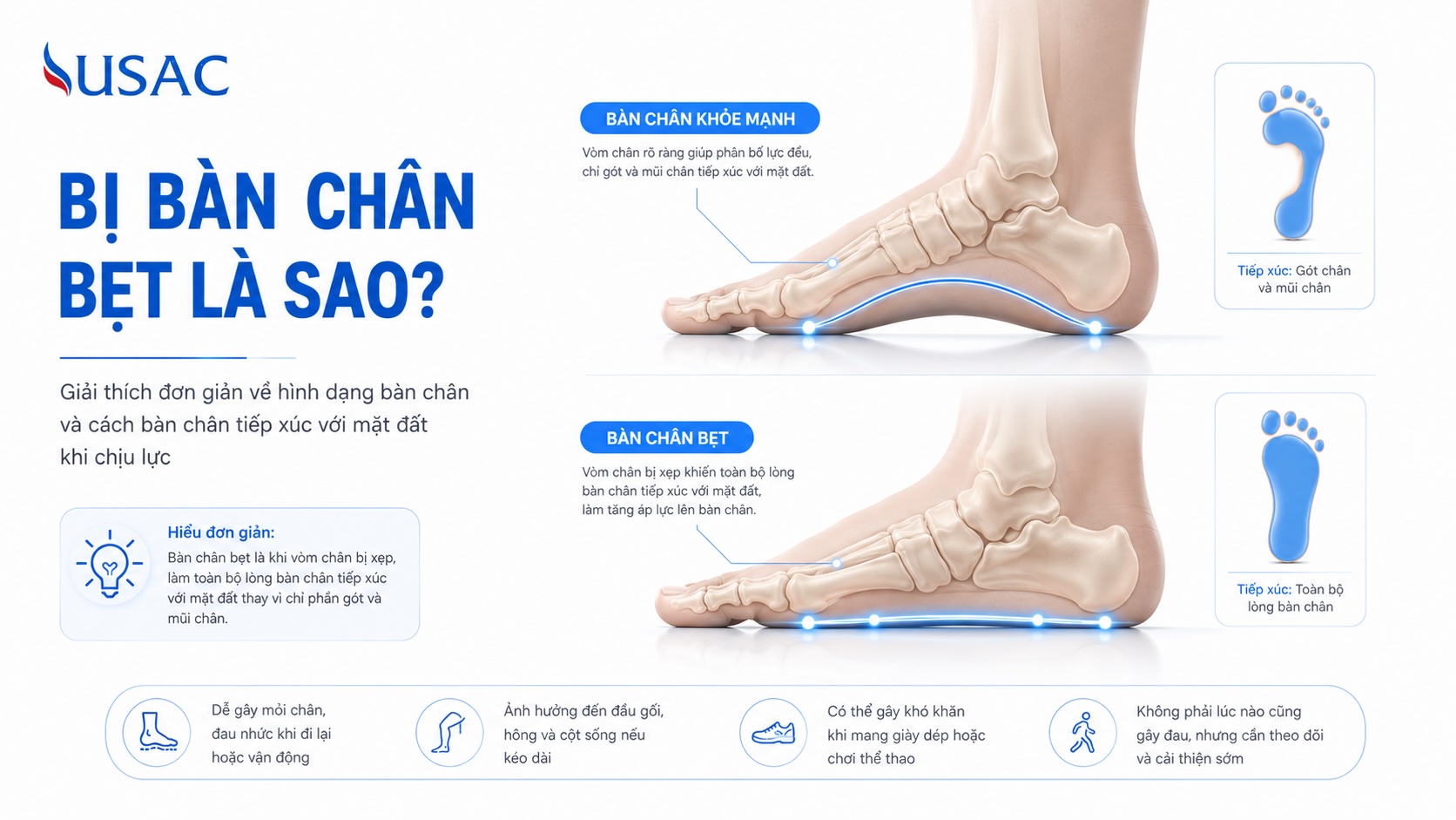 Bị Bàn Chân Bẹt Là Sao Bị Bàn Chân Bẹt Là Sao