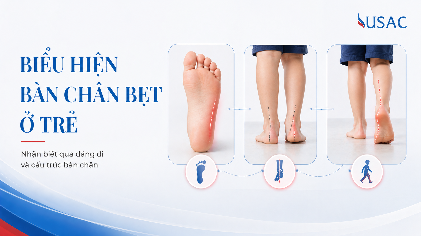 Biểu Hiện Bàn Chân Bẹt Ở Trẻ