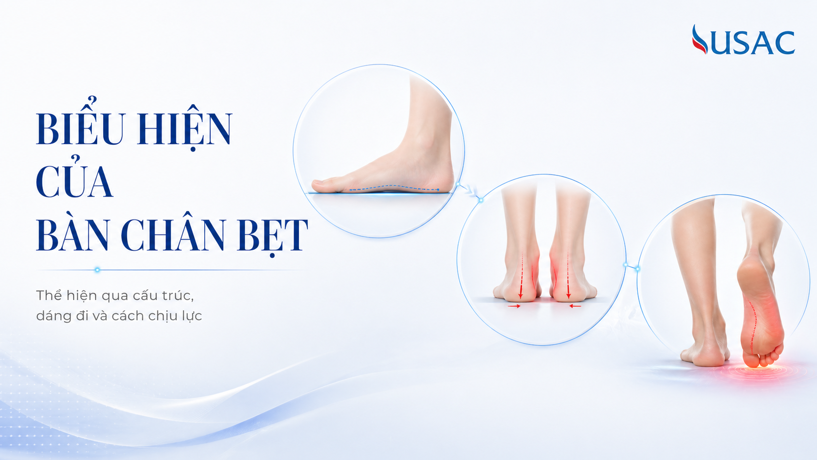 Biểu Hiện Của Bàn Chân Bẹt