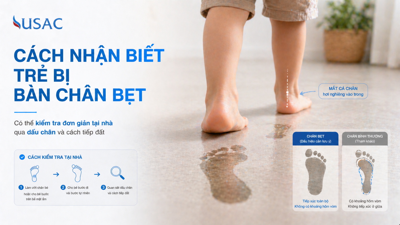 Cách Nhận Biết Trẻ Bị Bàn Chân Bẹt
