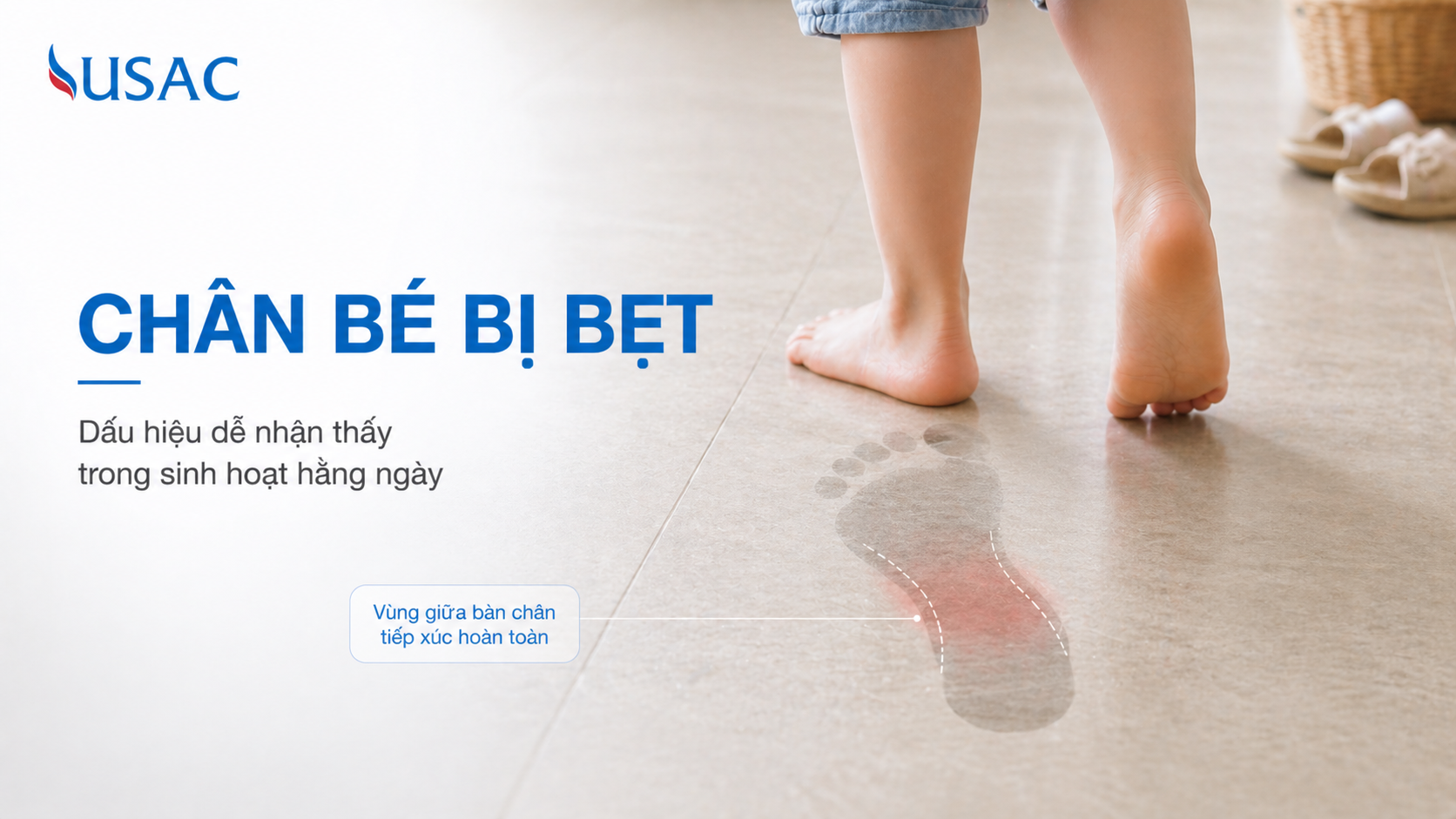 Chân Bé Bị Bẹt