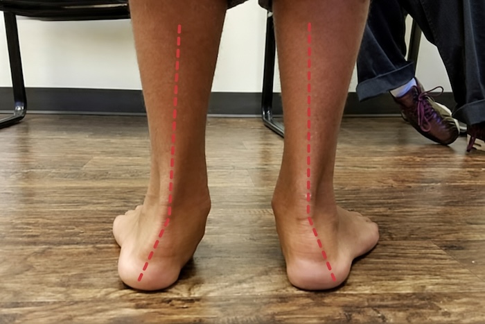 Chân Bẹt Có Sao Không