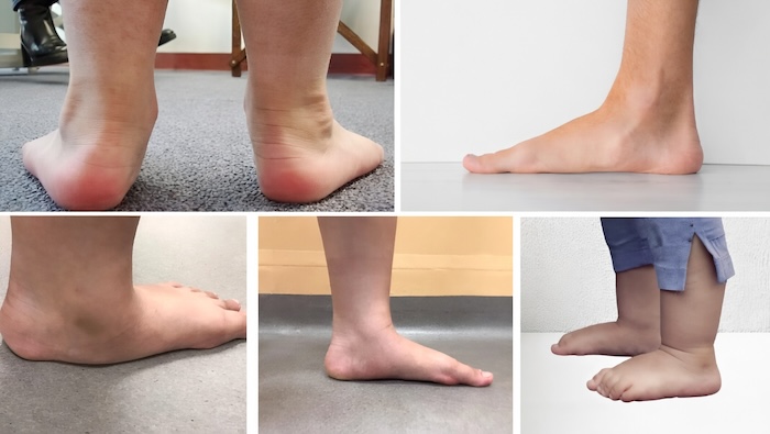 Chân Trẻ Bị Bẹt