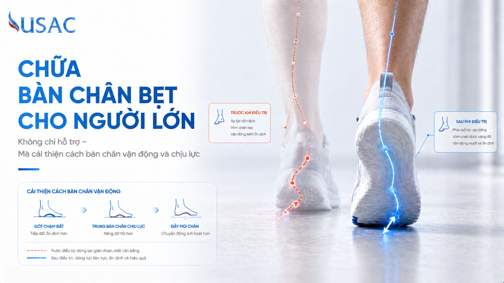 Chữa Bàn Chân Bẹt Cho Người Lớn Chữa Bàn Chân Bẹt Cho Người Lớn