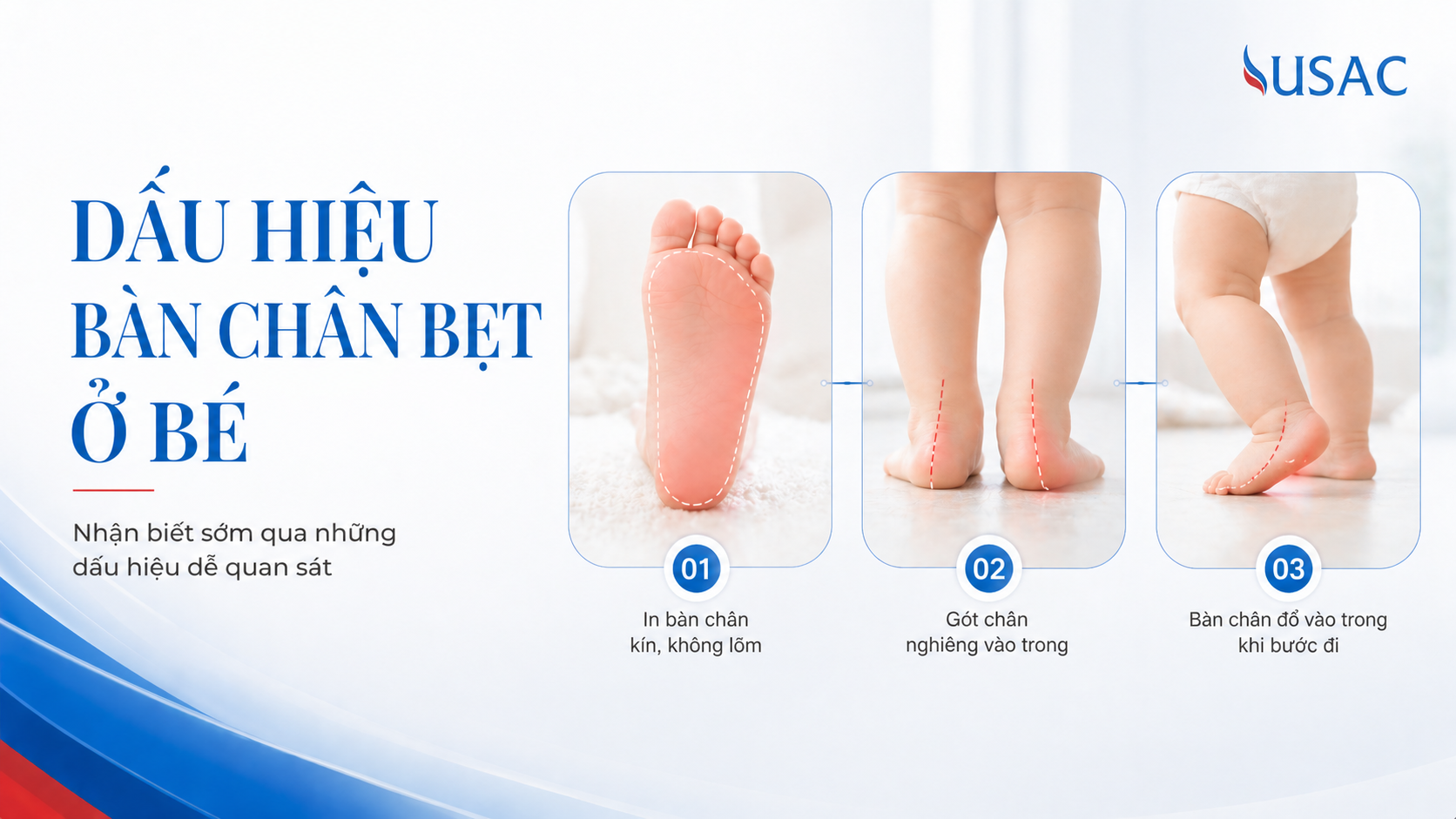 Dấu Hiệu Bàn Chân Bẹt Ở Bé