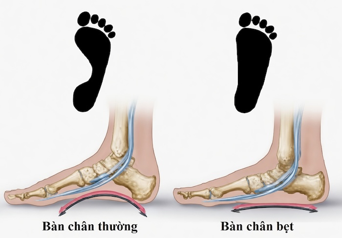 Dấu Hiệu Bàn Chân Bẹt Ở Trẻ Em