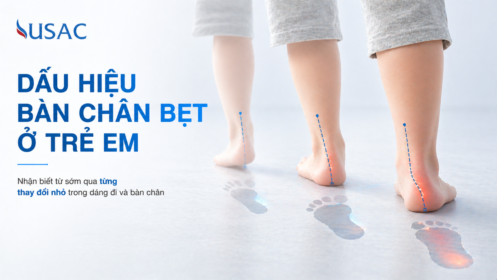 Dấu Hiệu Bàn Chân Bẹt Ở Trẻ Em