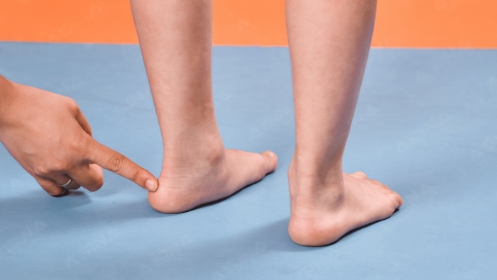 Dấu Hiệu Bé Bị Bàn Chân Bẹt