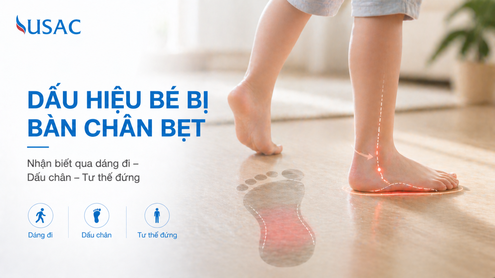Dấu Hiệu Bé Bị Bàn Chân Bẹt