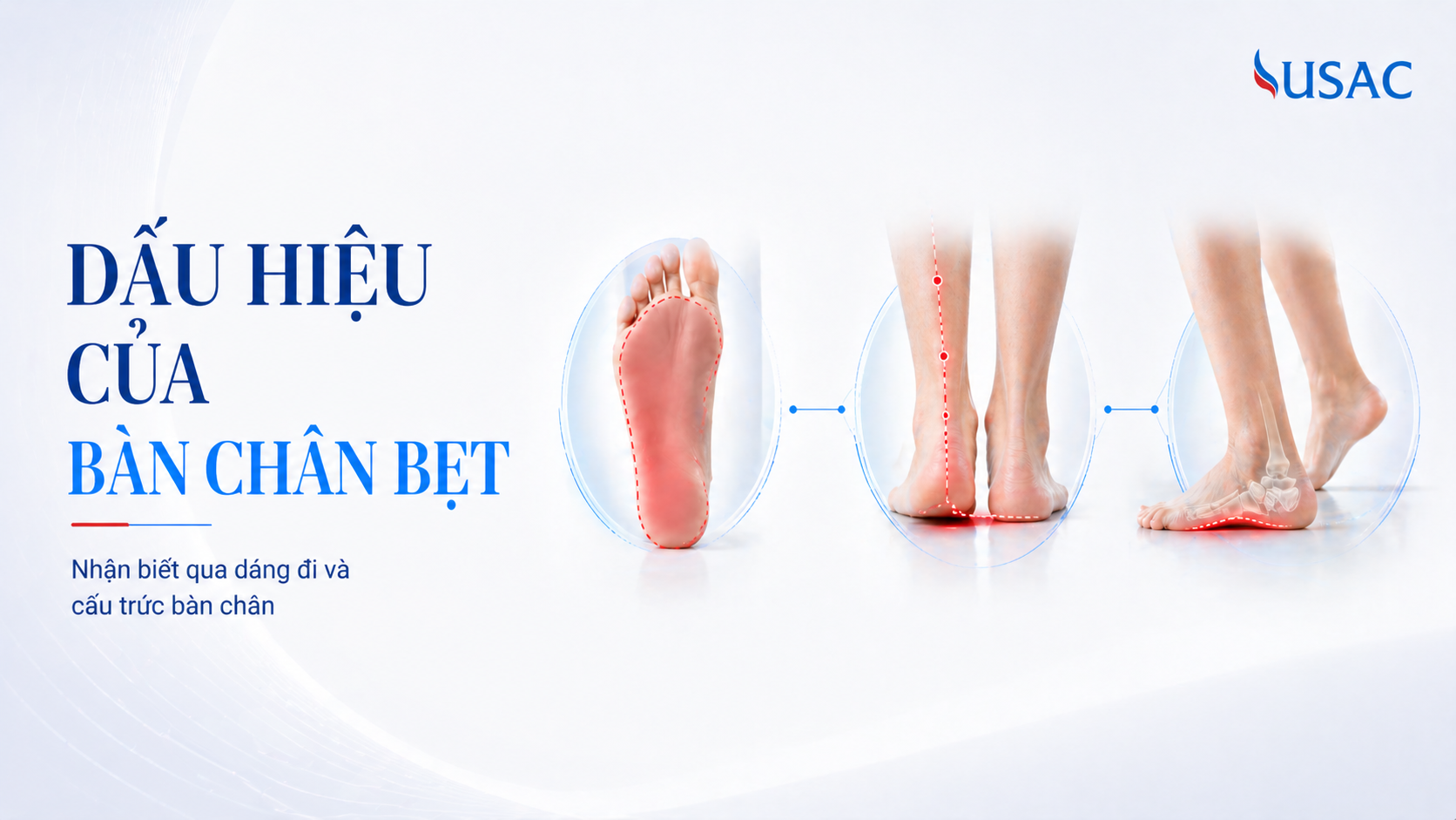 Dấu Hiệu Của Bàn Chân Bẹt