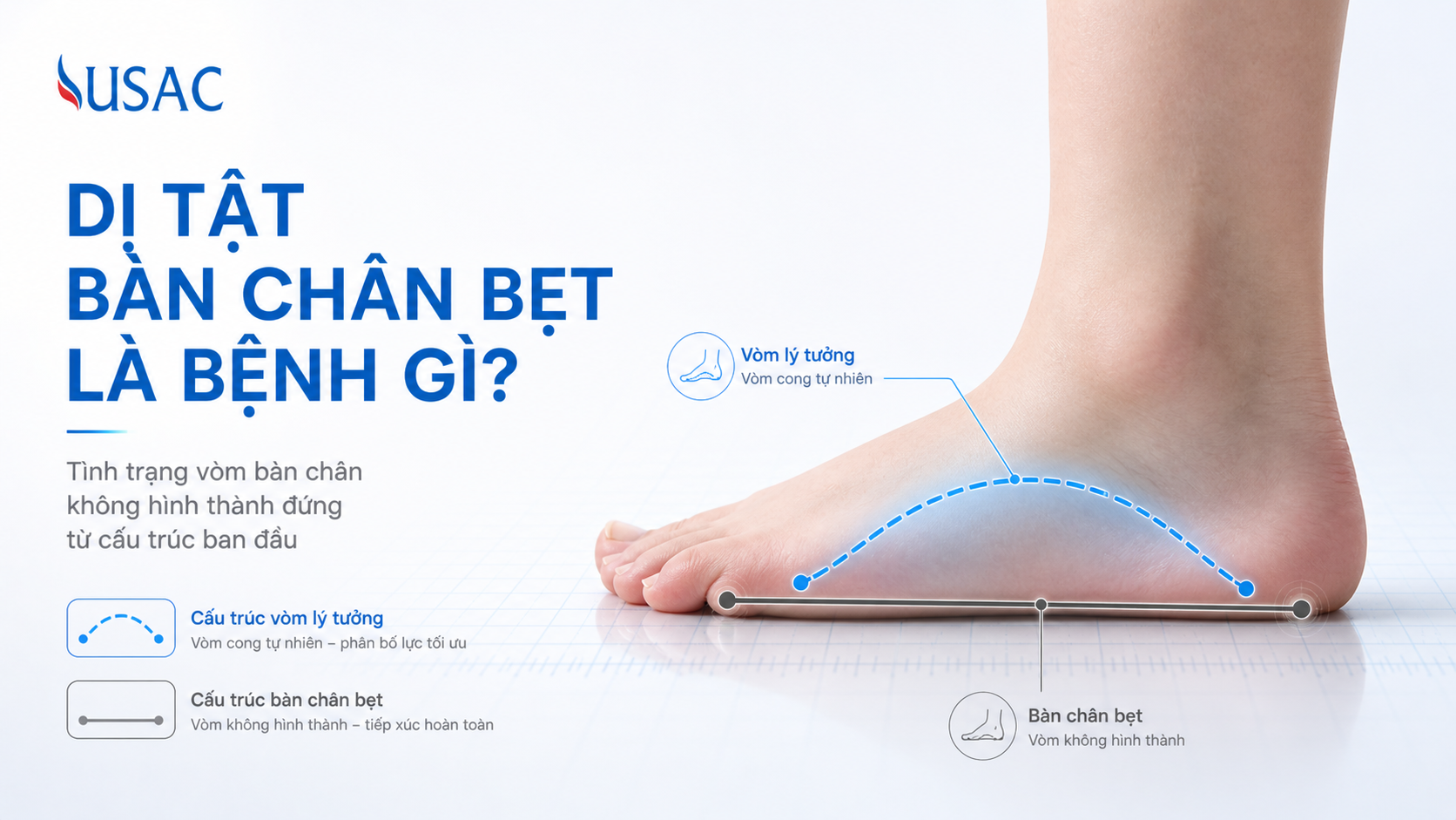 Dị Tật Bàn Chân Bẹt Là Bệnh Gì Dị Tật Bàn Chân Bẹt Là Bệnh Gì