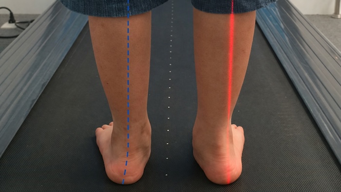 Điều Trị Bàn Chân Bẹt Cho Bé