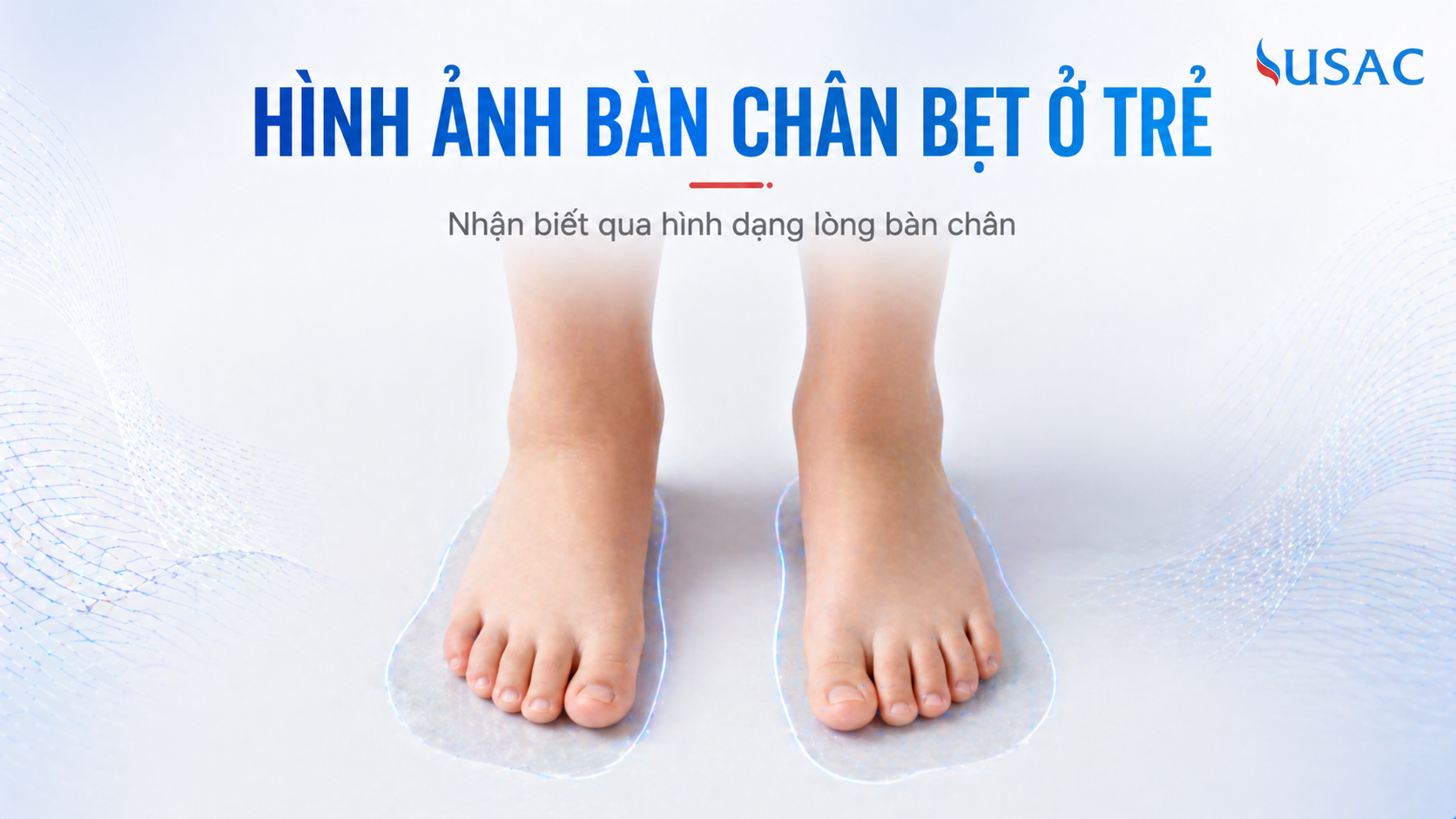 Hình ảnh bàn chân bẹt ở trẻ Hình ảnh bàn chân bẹt ở trẻ
