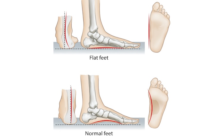 Hội Chứng Bàn Chân Bẹt Do Đâu