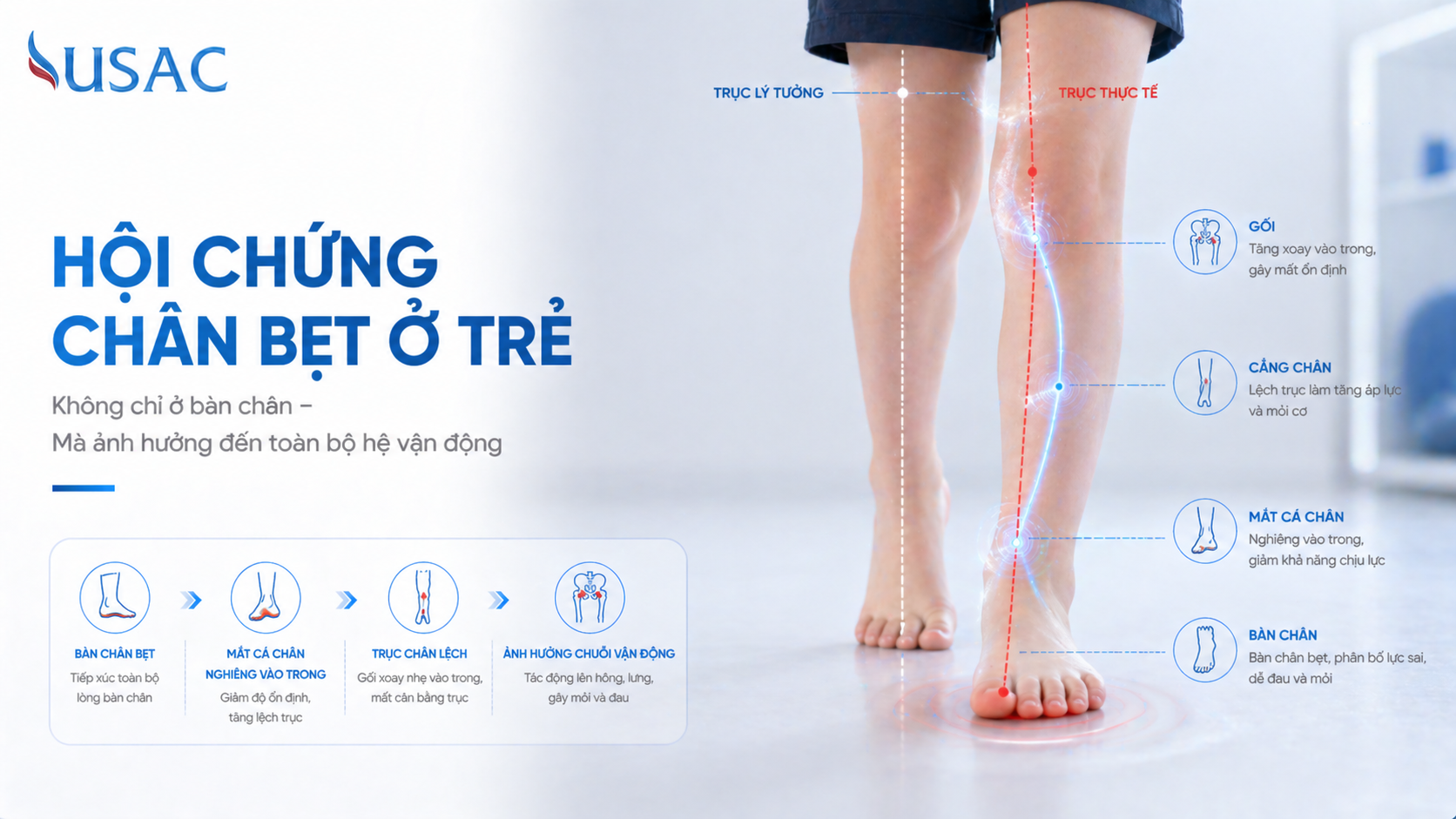 Hội Chứng Chân Bẹt Ở Trẻ Hội Chứng Chân Bẹt Ở Trẻ