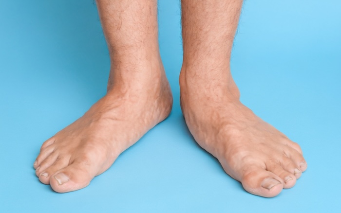 Khám Bàn Chân Bẹt Ở Đâu Hà Nội