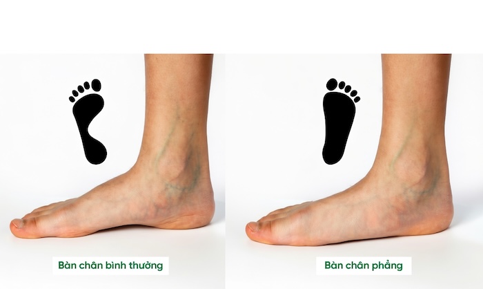 Lòng Bàn Chân Phẳng