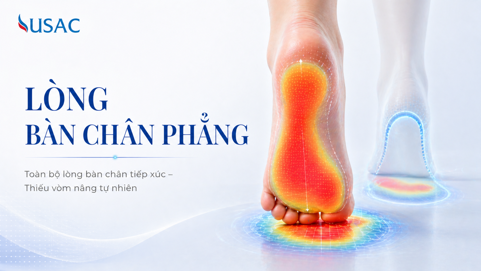 Lòng Bàn Chân Phẳng