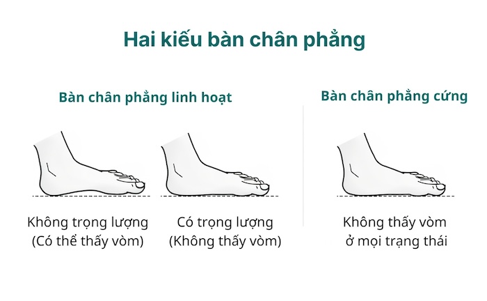 Lòng Bàn Chân Phẳng Có Ý Nghĩa Gì