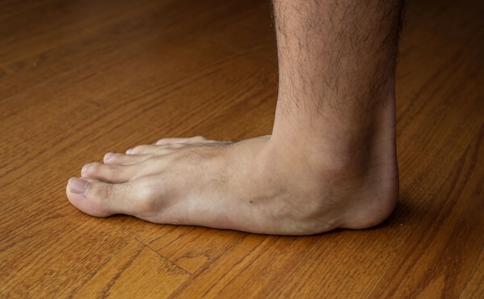 Người Có Bàn Chân Bẹt