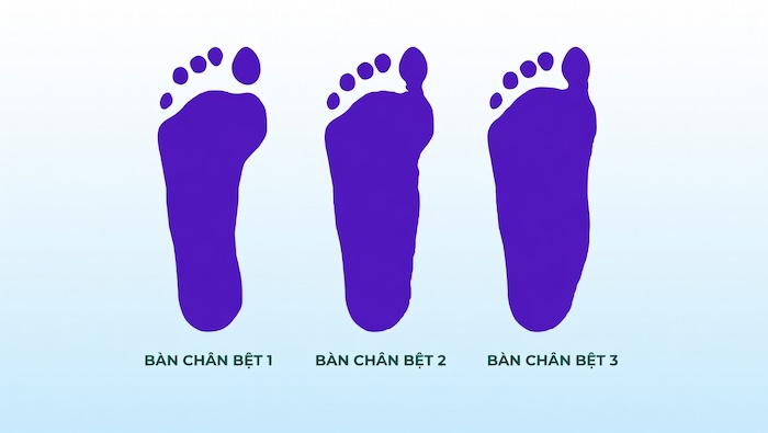 Nhận Biết Bàn Chân Bẹt Ở Trẻ