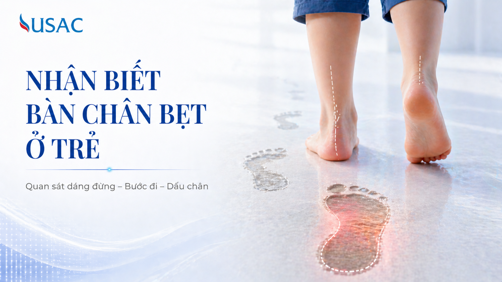 Nhận Biết Bàn Chân Bẹt Ở Trẻ