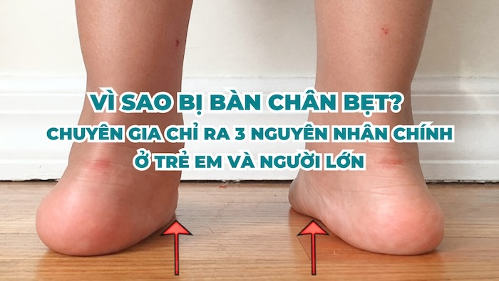 Tại Sao Bị Bàn Chân Bẹt