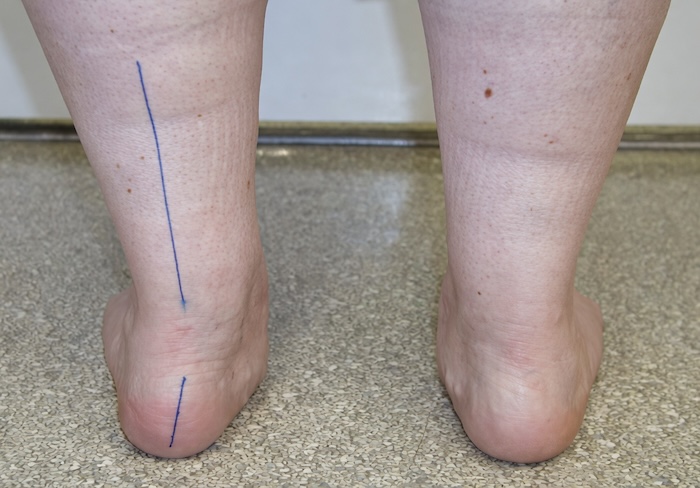 Tật Bàn Chân Bẹt Ở Trẻ