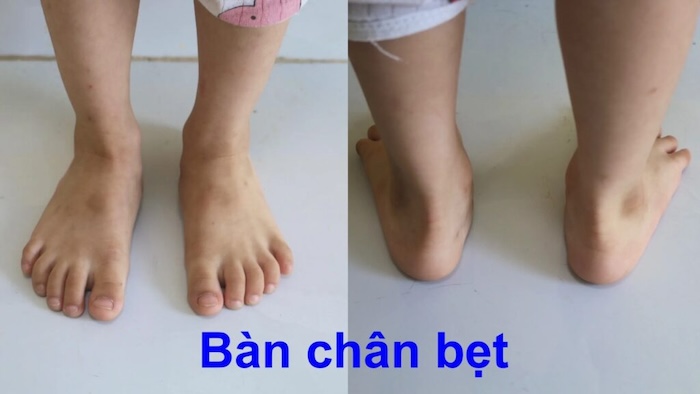 Trẻ Bị Bàn Chân Bẹt Có Nguy Hiểm Không