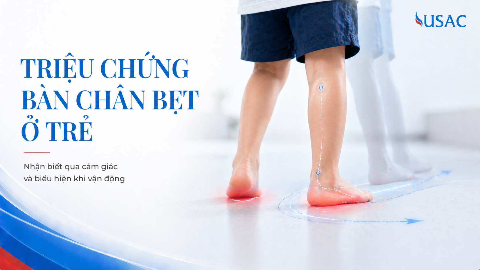 Triệu Chứng Bàn Chân Bẹt Ở Trẻ